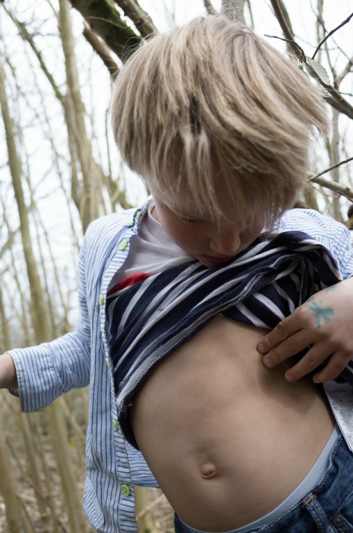 A boy of seven years lifts his stripey t-shirt to show a bite at the bottom of his rib cage. He is standing in a wooded area.